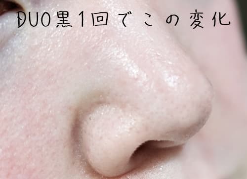 毛穴の黒ずみは、一回でこのくらいの変化です！
