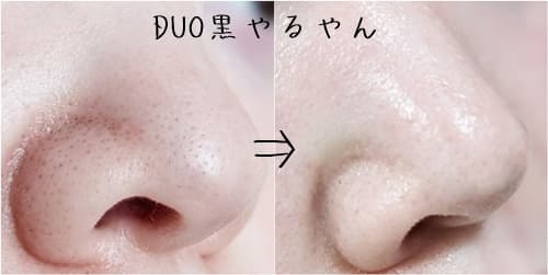 DUO黒をいちご鼻に使ってみたビフォーアフター