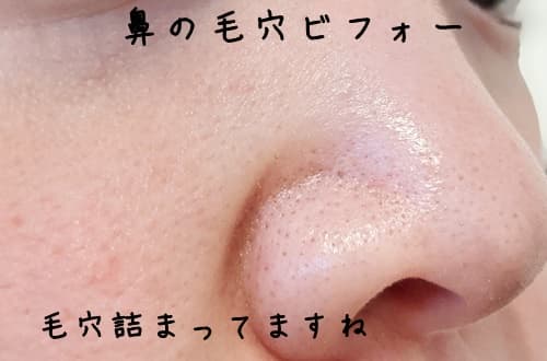 なかなかに毛穴が詰まってますね～
この毛穴がベビーオイル洗顔でなくなるのか？