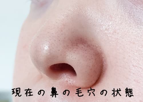 現在の毛穴の状態はこんな感じ
