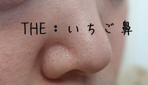 今朝のいちご鼻の状態はこんな感じです。