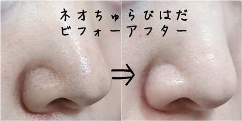 ネオちゅらびはだの鼻のビフォーアフター