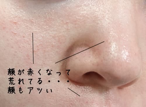 ニベアパックで顔が赤くなってしまった