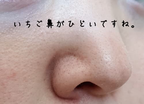 今のいちご鼻の状態を確認しておきます