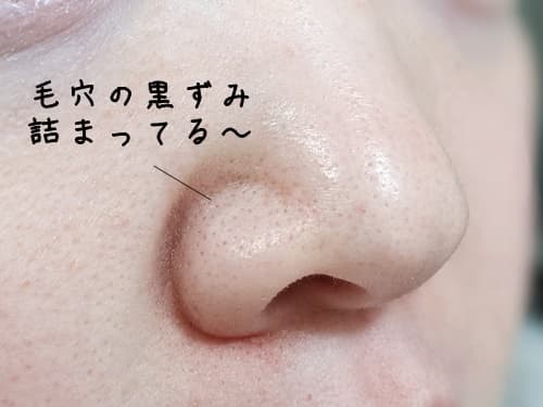 シカクレンジングバームの毛穴の黒ずみへの効果