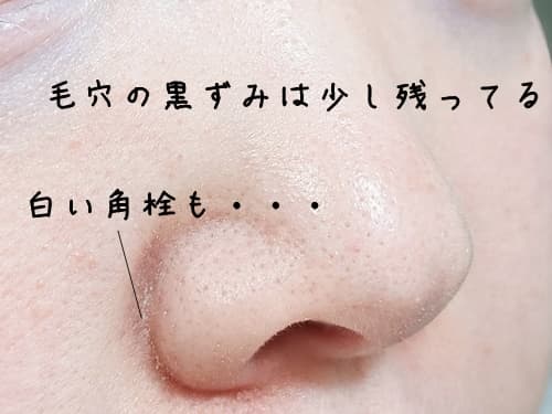 うーん、黒ずみは残ってますね。
