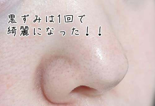 いちご鼻のビフォーアフター写真