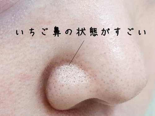 今朝の毛穴の状態はこんな感じでした。
