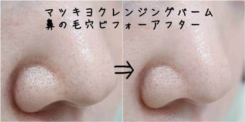 鼻のビフォーアフター