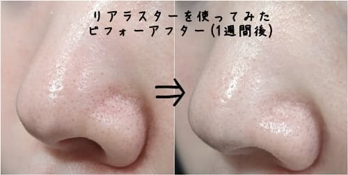鼻の毛穴のビフォーアフター