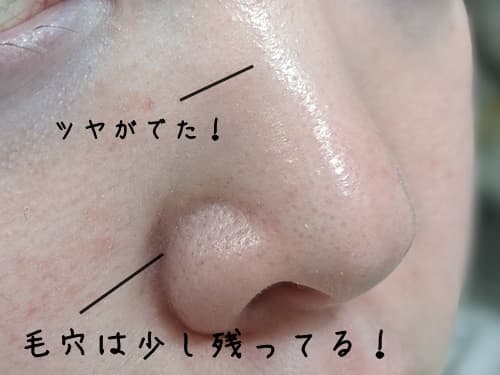 ルルルンクレンジグバームの毛穴の黒ずみ・角栓への効果