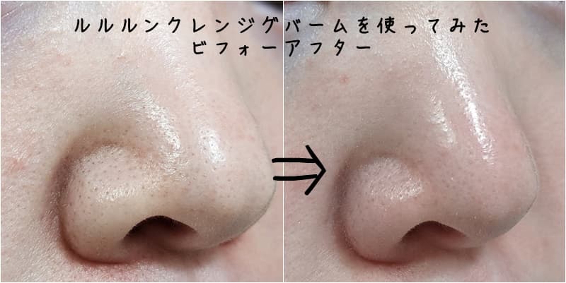 ルルルンクレンジグバームの毛穴のビフォーアフター写真