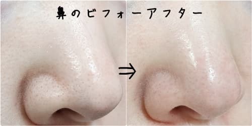DUOホットの鼻のビフォーアフター