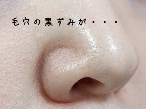 使用前の、鼻の黒ずみの状態はコチラです↓↓