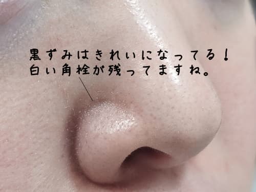 黒ずみは落ちて、角栓は残る・・