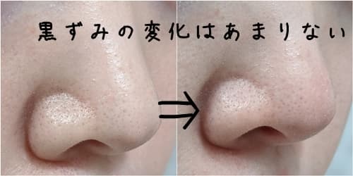 鼻のビフォーアフター