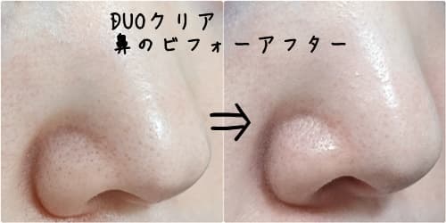 DUOクリアを使ってみた、鼻の黒ずみのビフォーアフター