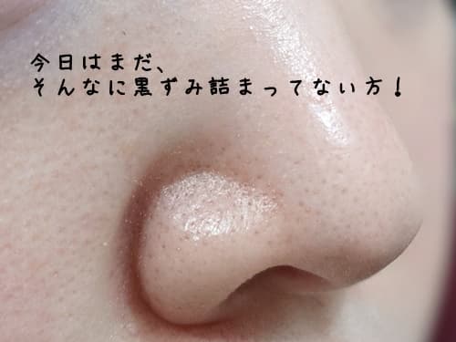 恒例の毛穴の黒ずみチェックをします。