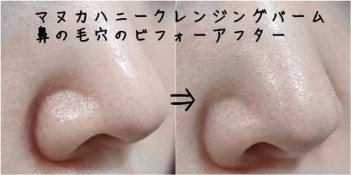 鼻の毛穴のビフォーアフター写真