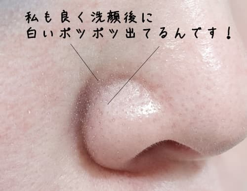 洗顔後の毛穴の白いポツポツの正体何?